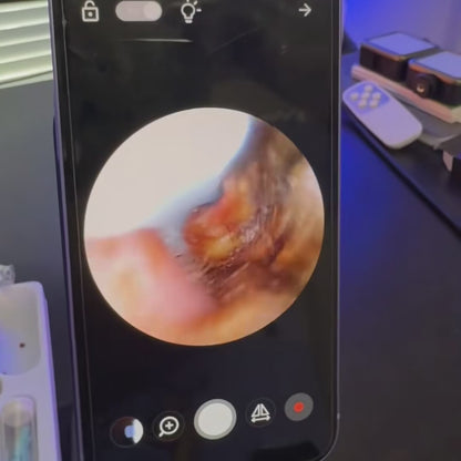 CalmEar™ - Limpieza Profesional de Oídos